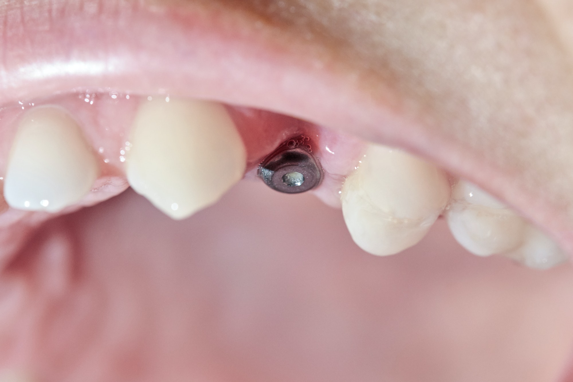 Real mouth with dental molar screw implant.